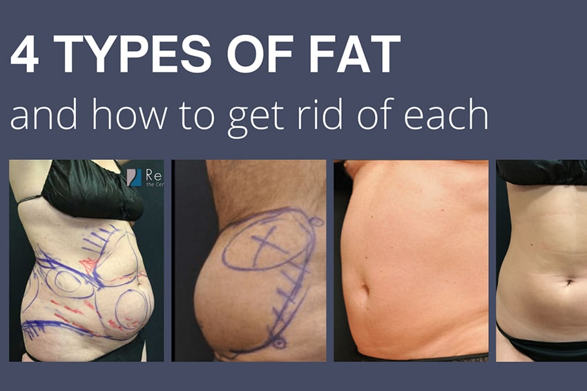 Liposuction Surgery- Get Rid Of Excess Fat & Shape Your Body