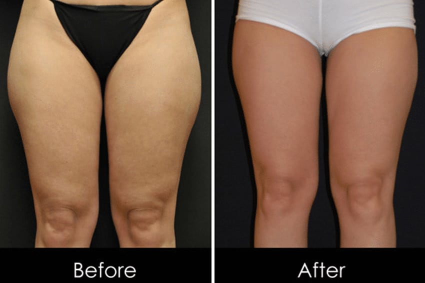 How to Tighten Loose or Saggy Skin on Thighs
