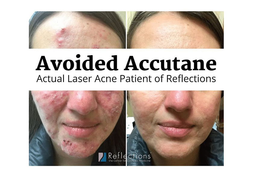 accutane before and after bacne