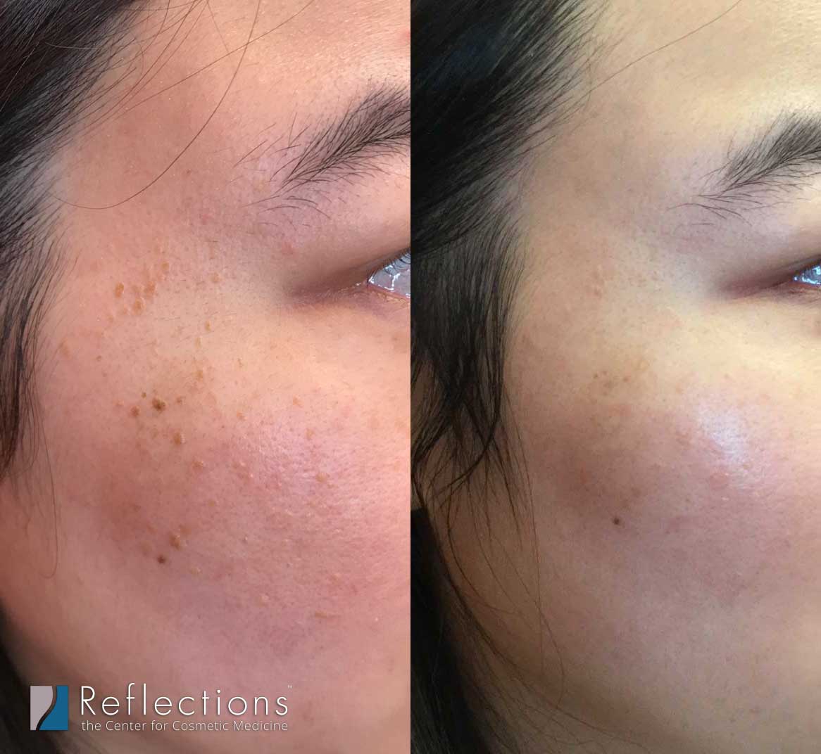 Skin Classic High Frequency Radiofrequency Before & After Photos New Jersey