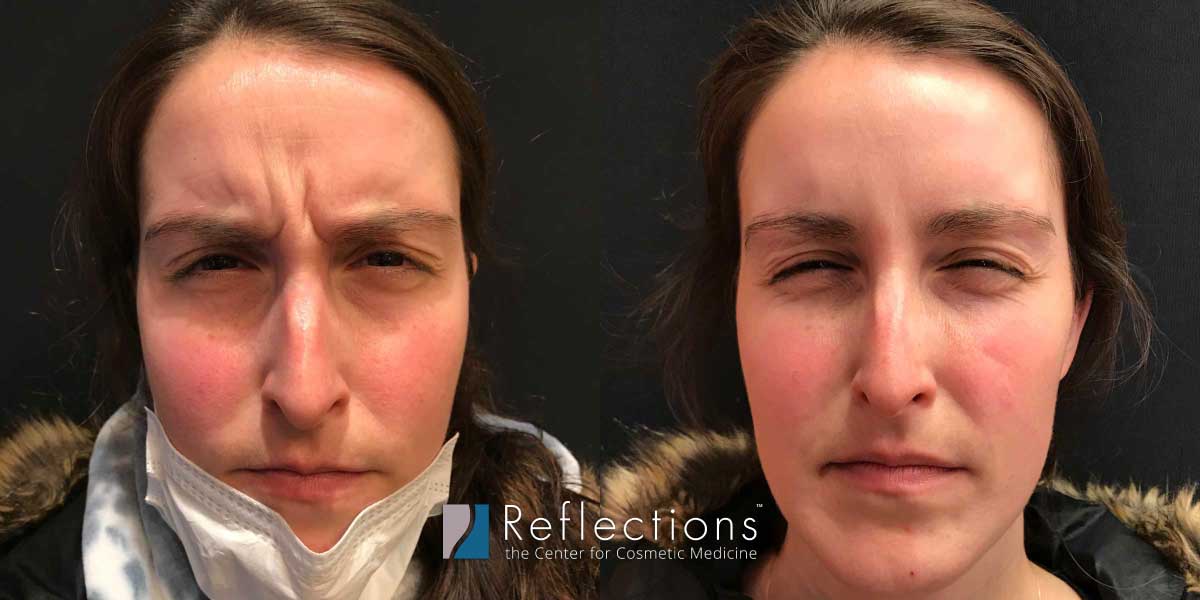 First Time Botox Results At 30 Before And After Photos New Jersey