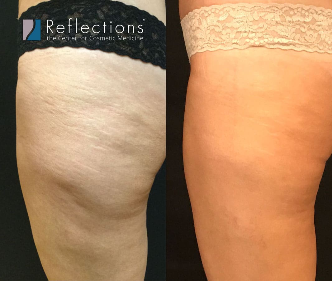 How to Get Rid Of Cellulite On Thighs, Legs and Butt - Cellulite Removal  Treatments