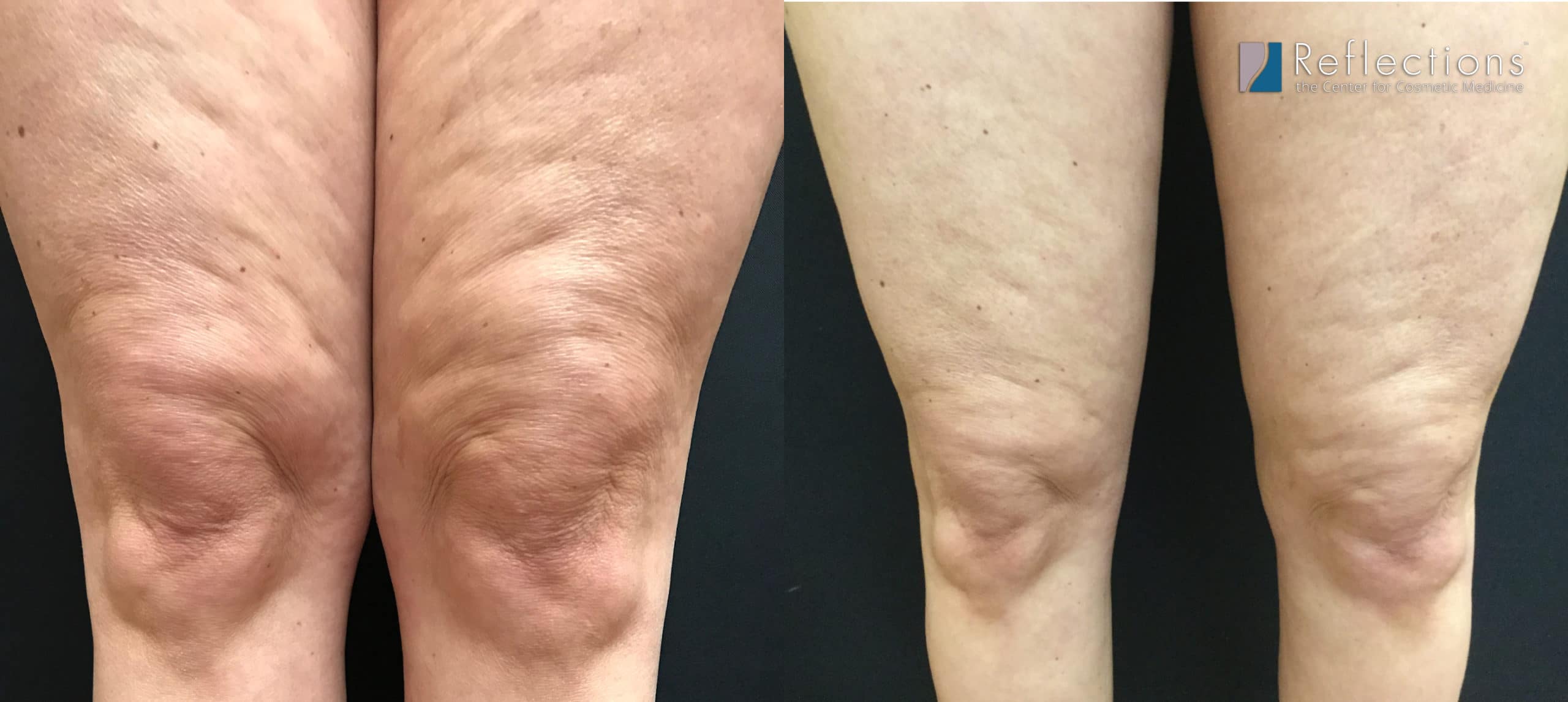 Thigh & Knee Liposuction procedure permanently removes fat