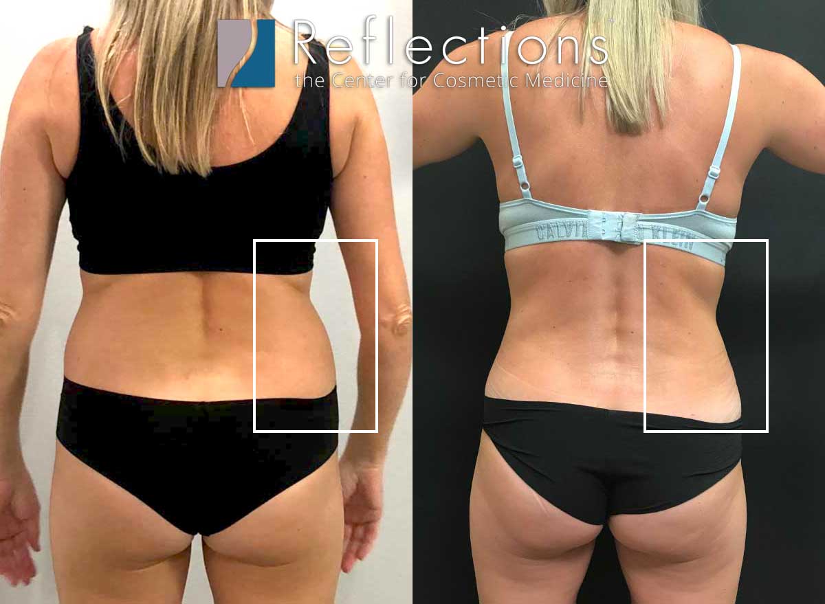 Smartlipo & Vaser for Snatched Waist & No More Love Handles! Before & After  Photos New Jersey - Reflections Center