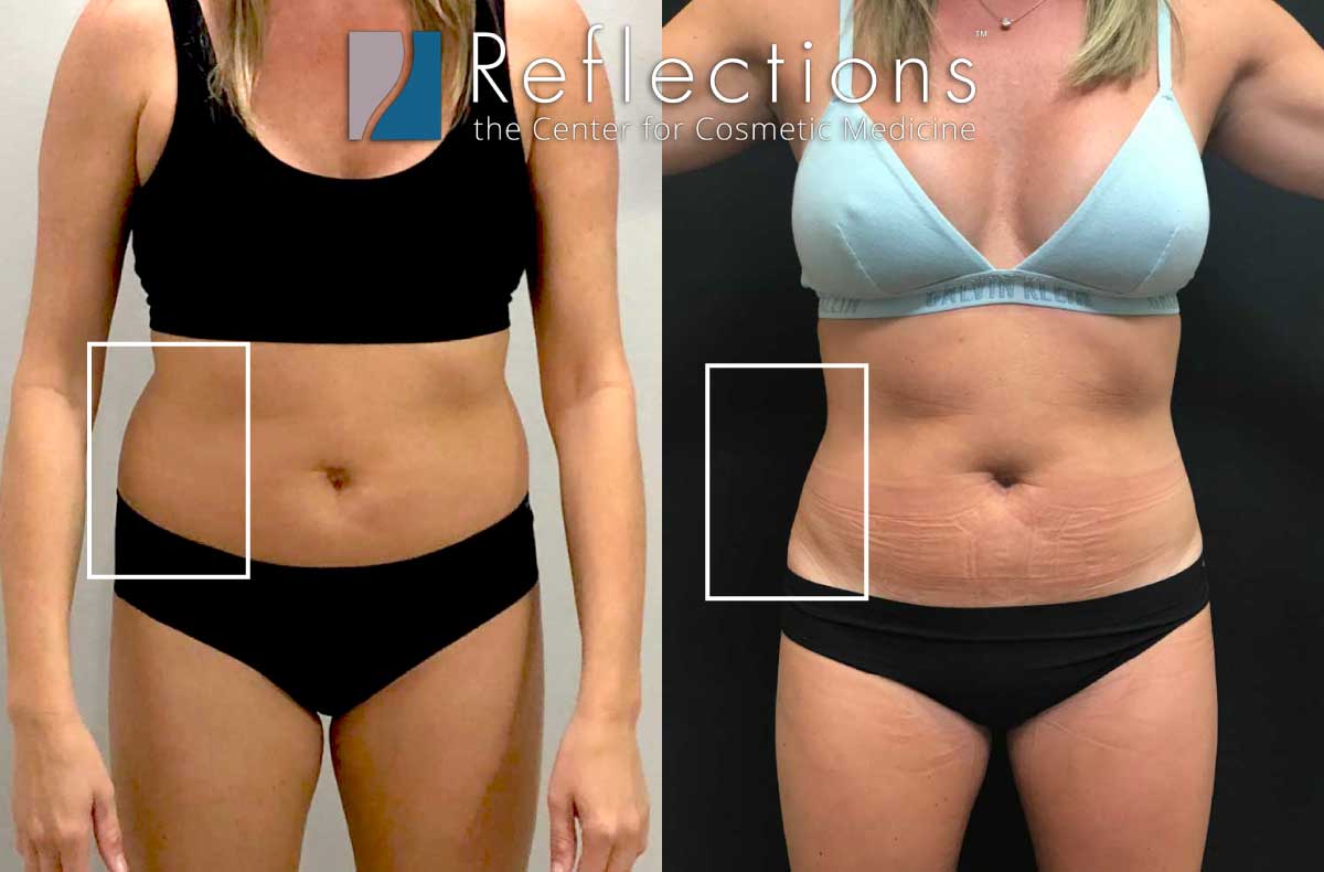 Eliminate Love Handles with Liposuction of the Flanks!