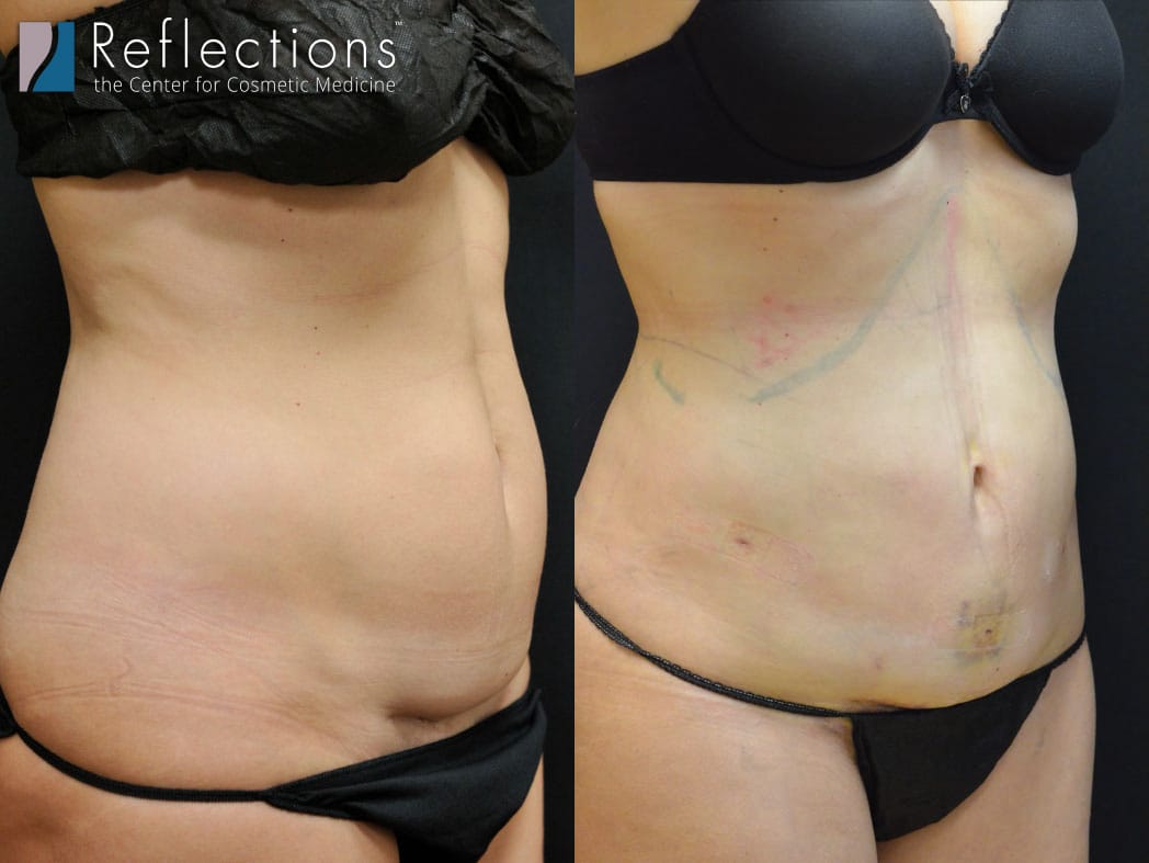 What to Expect Post Liposuction — Cleverly Catheryn