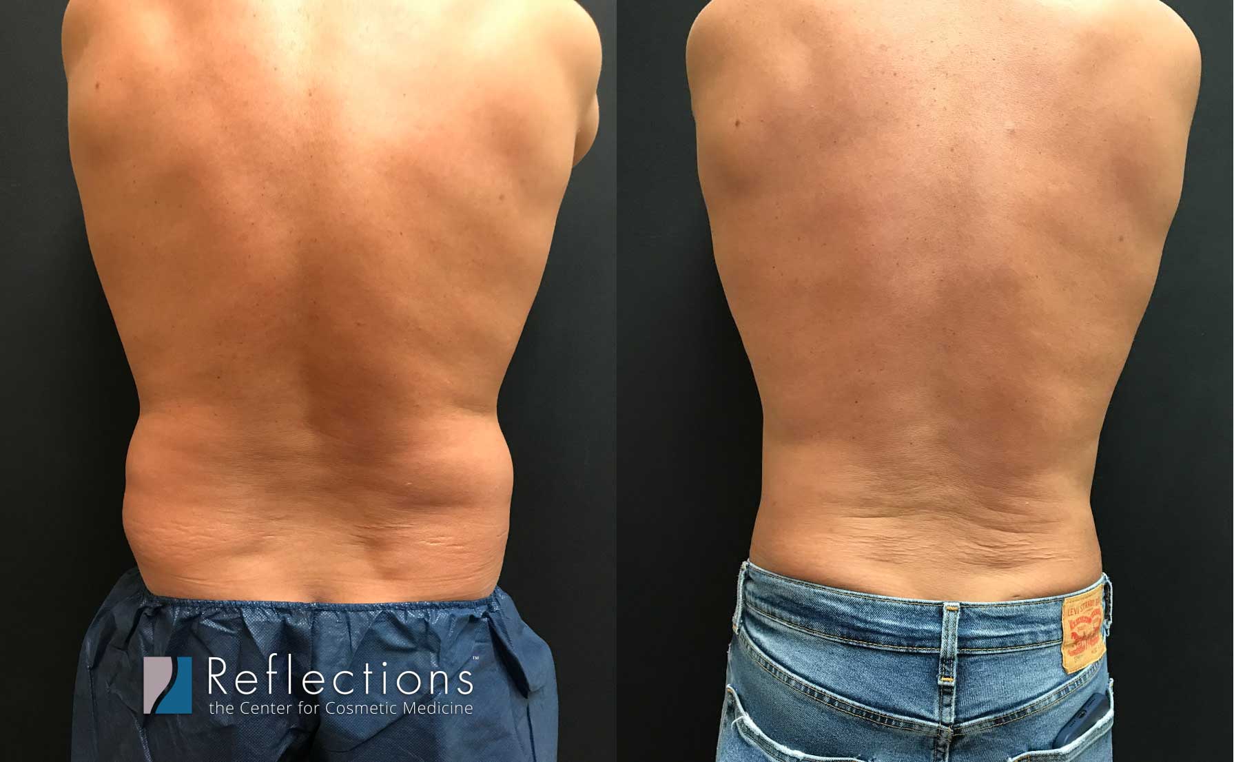 Male Lipo To Get Rid Of Love Handles Without Anesthesia Or Long