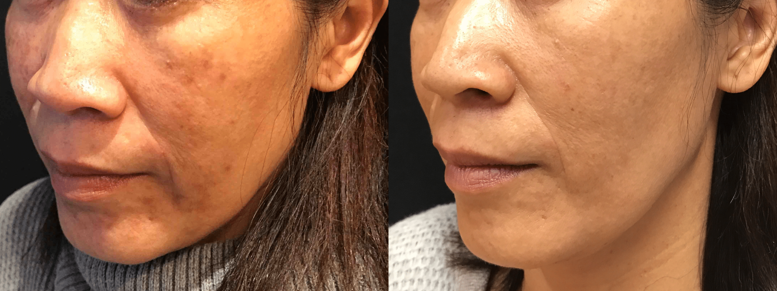 Melasma Hyperpigmentation Treatment PA Melasma Removal Philadelphia 