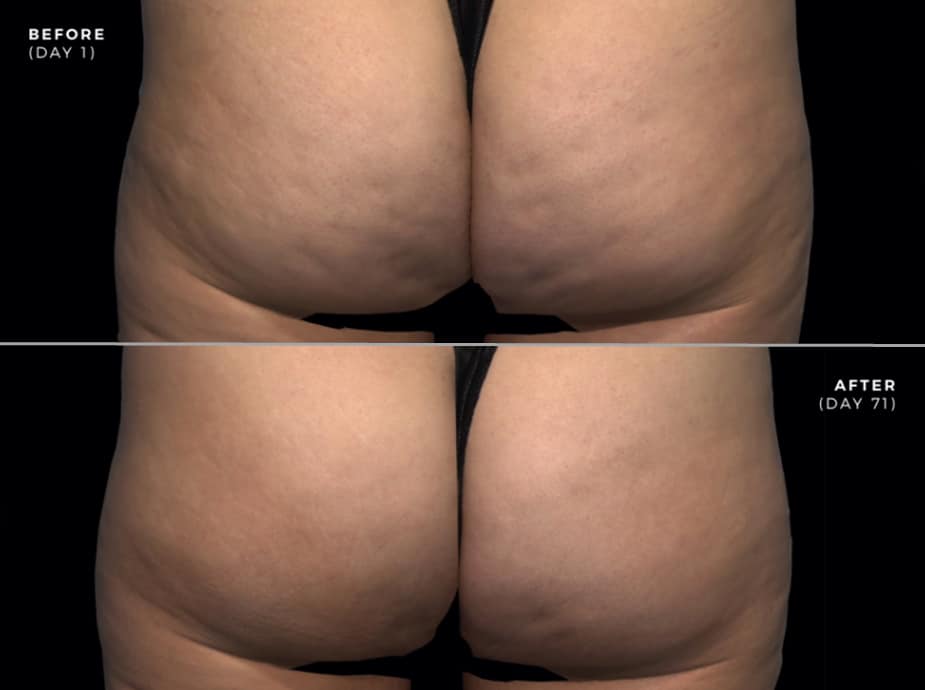 9x REAL cellulite treatment before and after pictures - LipoTherapeia