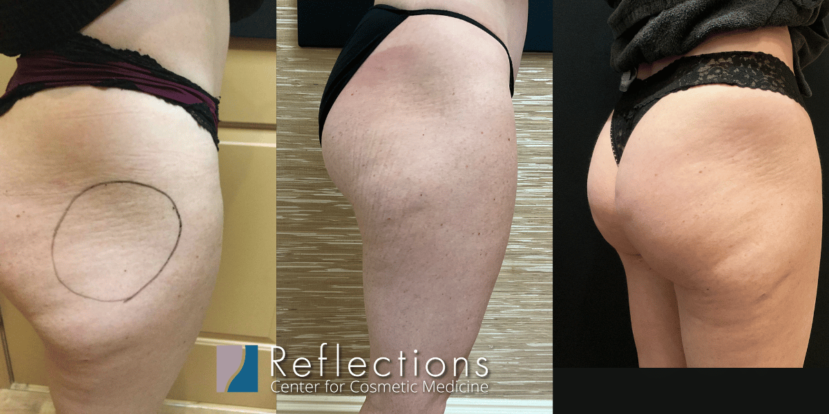 Sculptra Injections for Rounder Butt [Hip Dips] Before & After