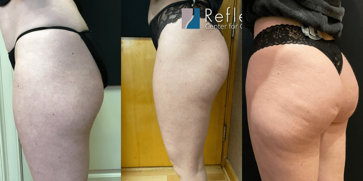 Sculptra Injections for Rounder Butt [Hip Dips] Before & After Photos New  Jersey - Reflections Center
