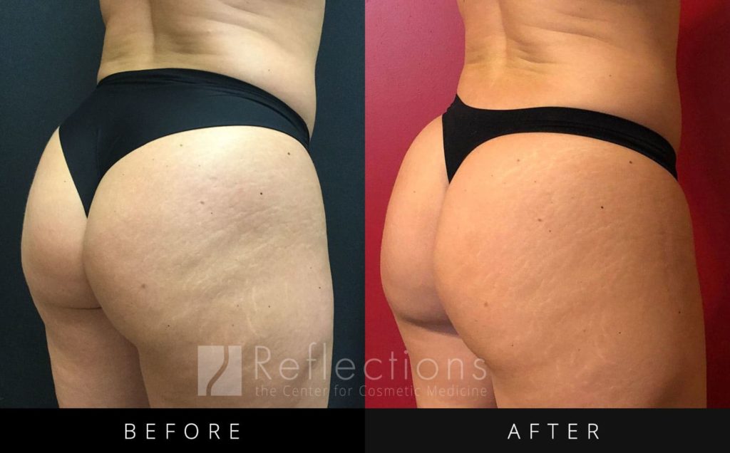 Non-Surgical Butt Lifts Really Work