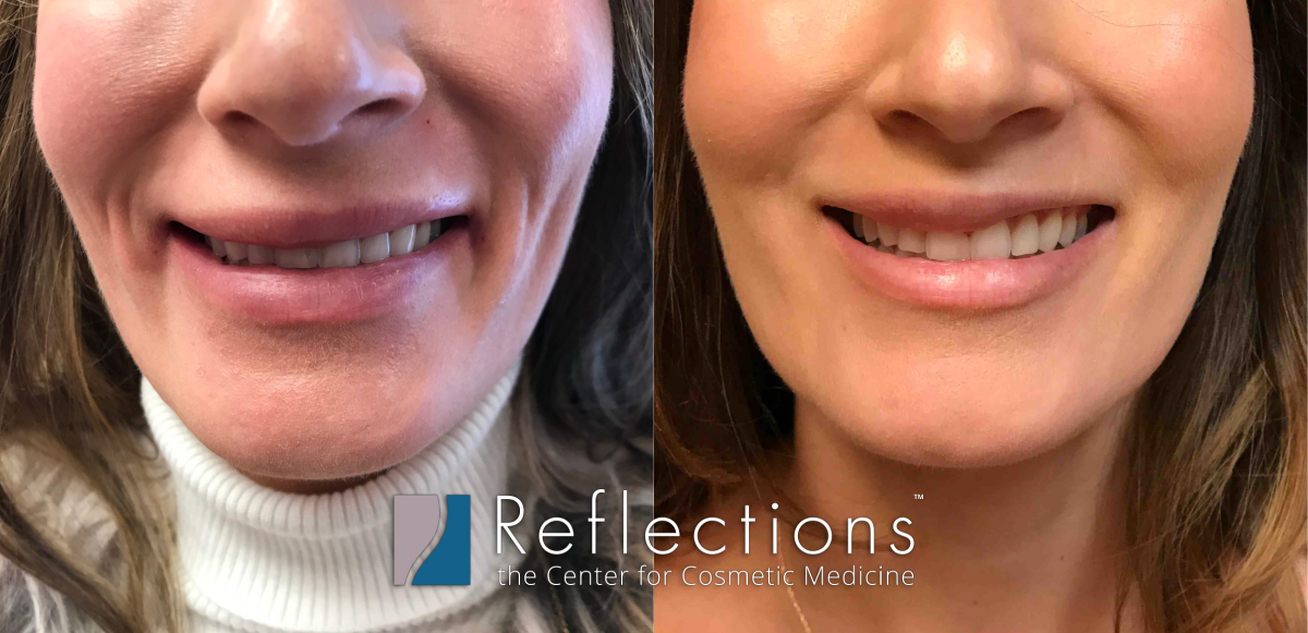 Uneven Smile Fixed With Botox Before And After Photos New Jersey Reflections Center