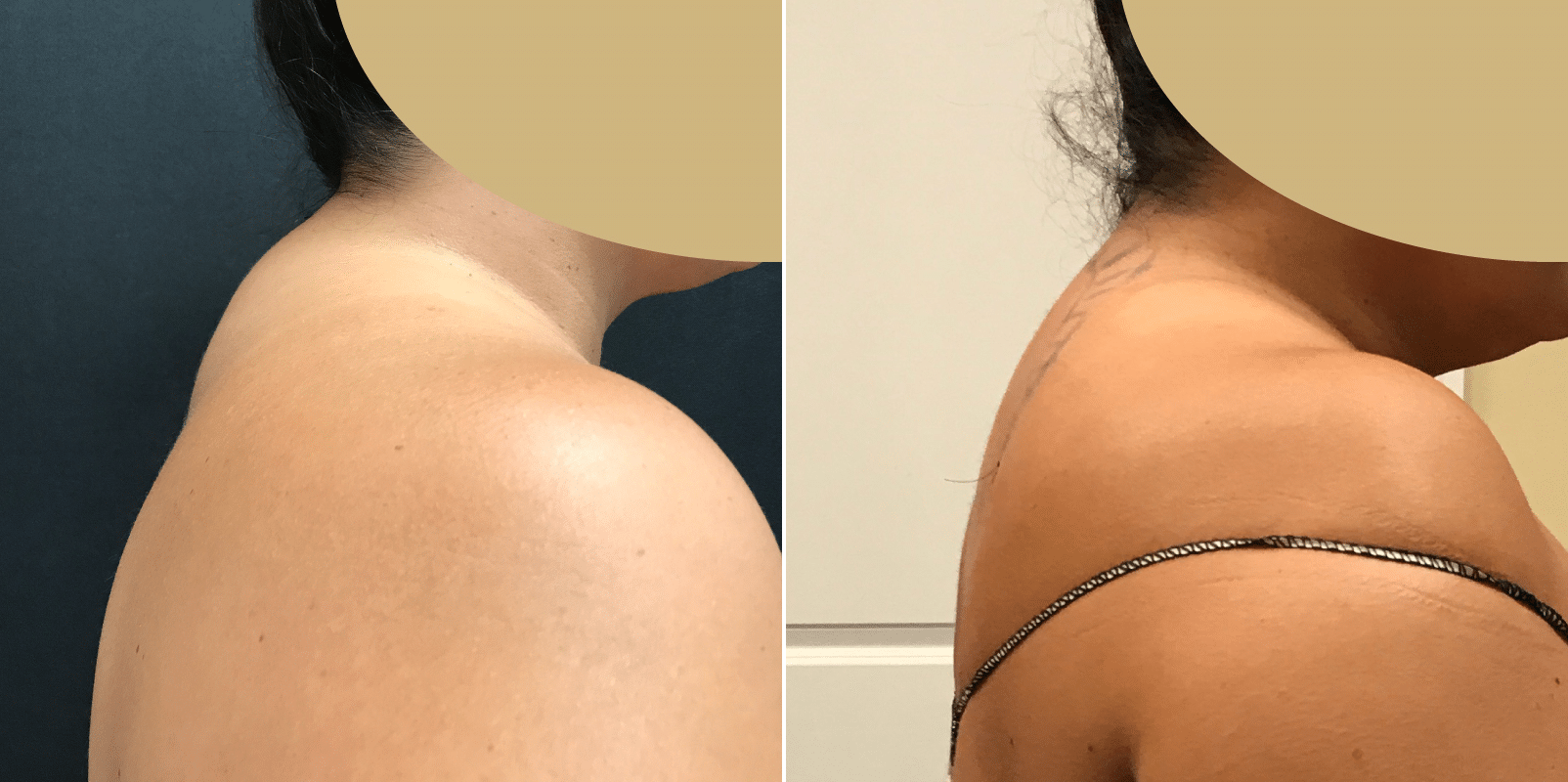 Smartlipo of the Back - Flanks, Bra Rolls, and Neck Humps