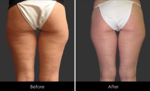 What to do about Inner Thigh Sagging