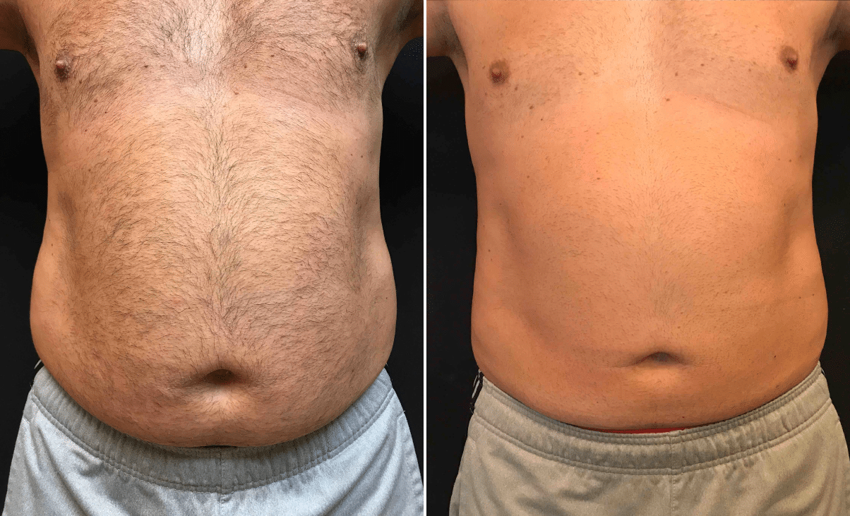 Coolsculpting And Sculpsure For Male Belly Beer Belly Be Gone Before