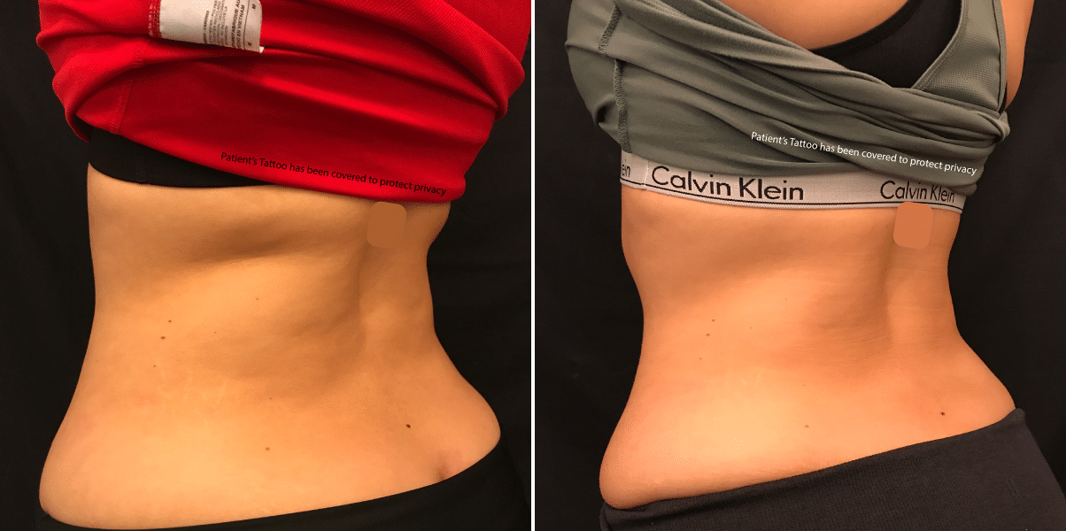 Can CoolSculpting Reduce Underarm Breast Tissue? - NJ Center for  CoolSculpting