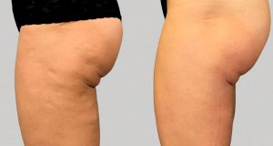 Non-Surgical Butt Augmentation New Jersey - Reflections Center
