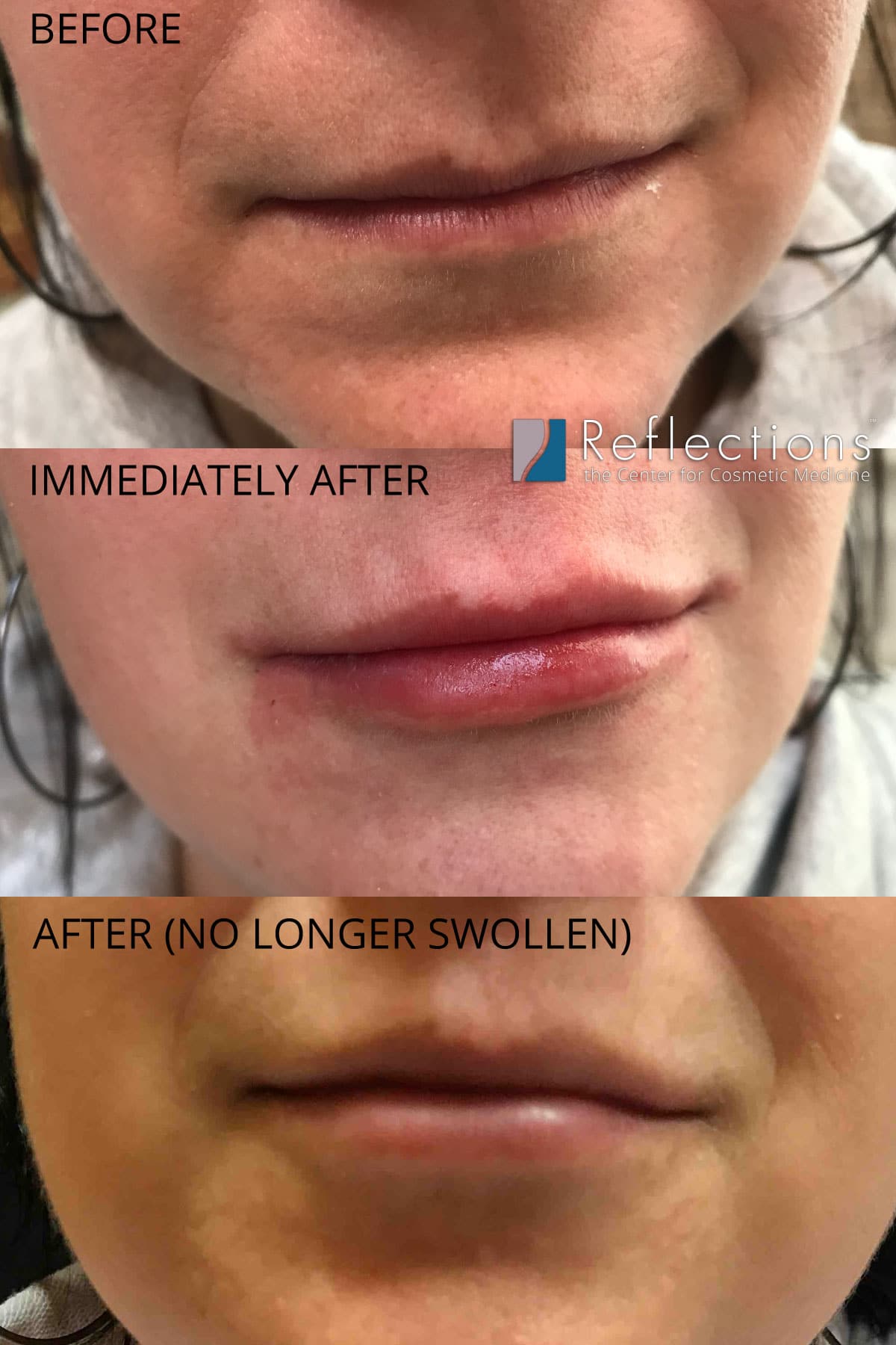 Female Lip Filler With Restylane Kysse Immediately After Lip Filler