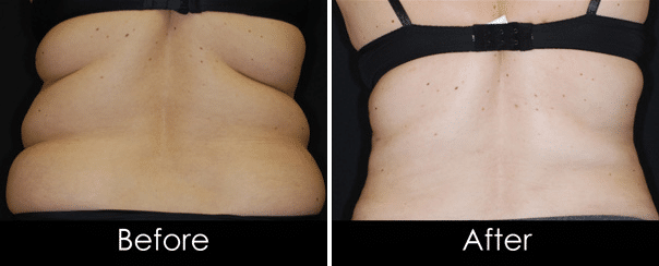 Liposuction of Bra Fat 