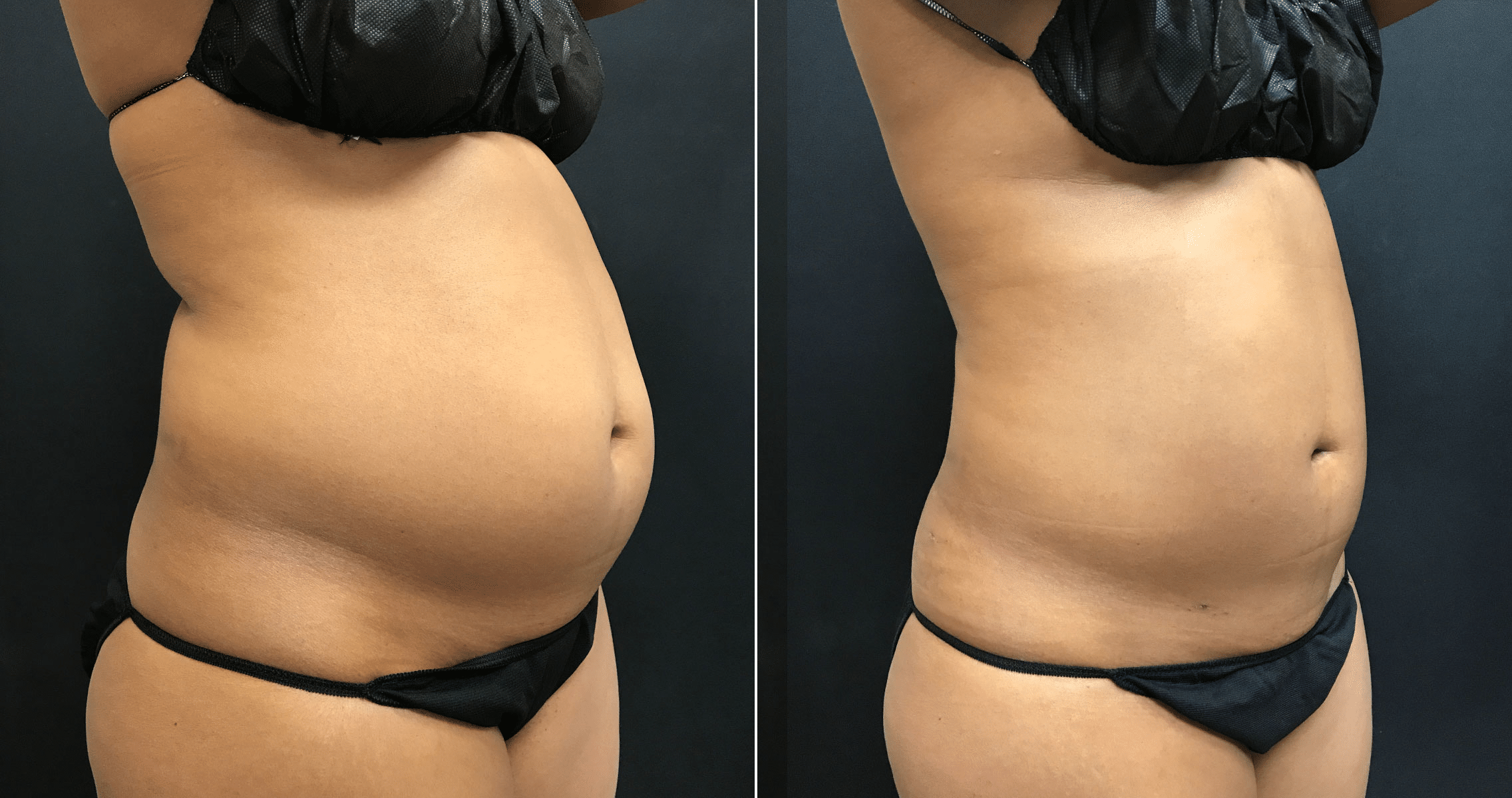 I have saggy boobs, a belly, back rolls and cellulite – I let it