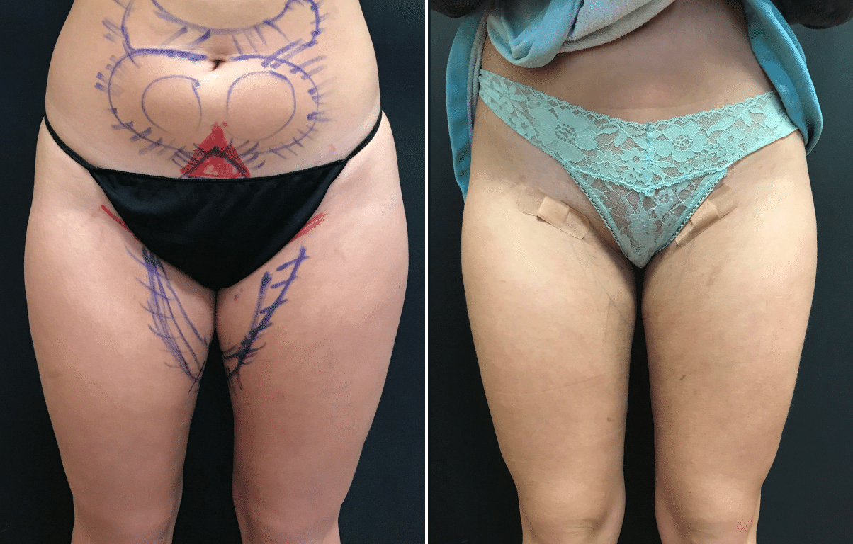 Different types of Liposuction: techniques & best options, newest