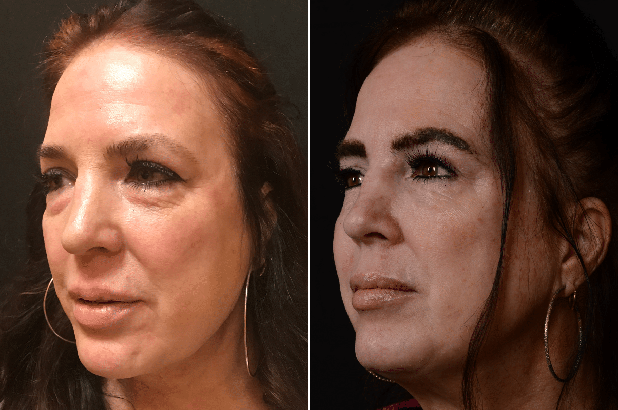 Puffy Eyes and Bags with Eyelid Surgery