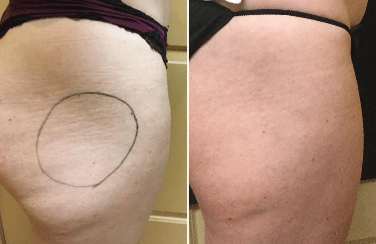Before and After Non-Surgical Treatment of Hip Dips