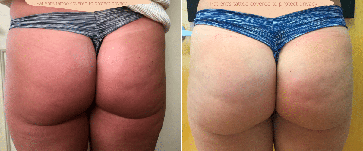 Patient 65642128  Booty-Ful Butt Lift® Before & After Photos