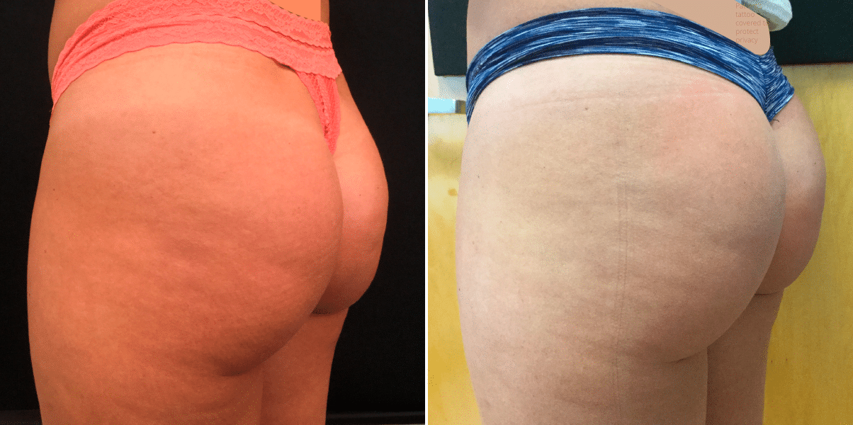 NON-SURGICAL BUTT-LIFT WITH SCULPTRA AND RADIESSE, Before & After