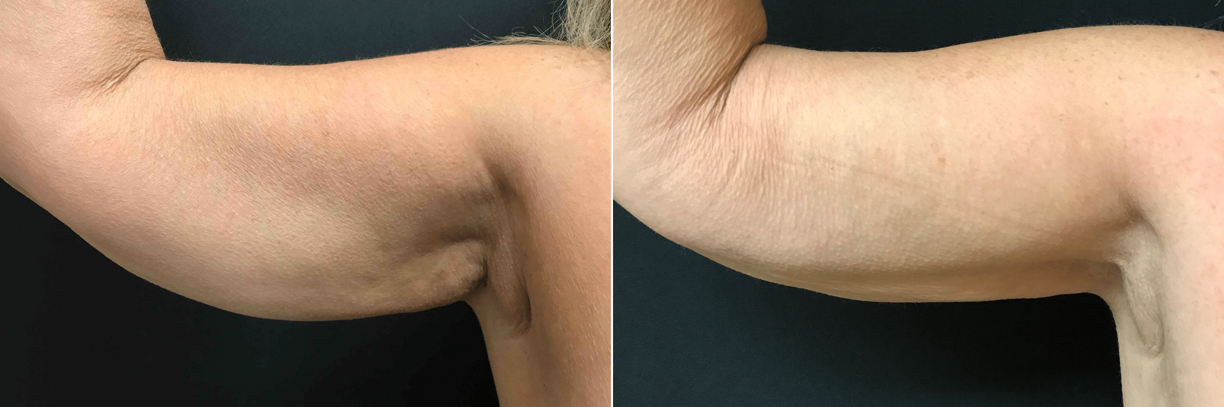 Skinny Arm Flexing Image & Photo (Free Trial)