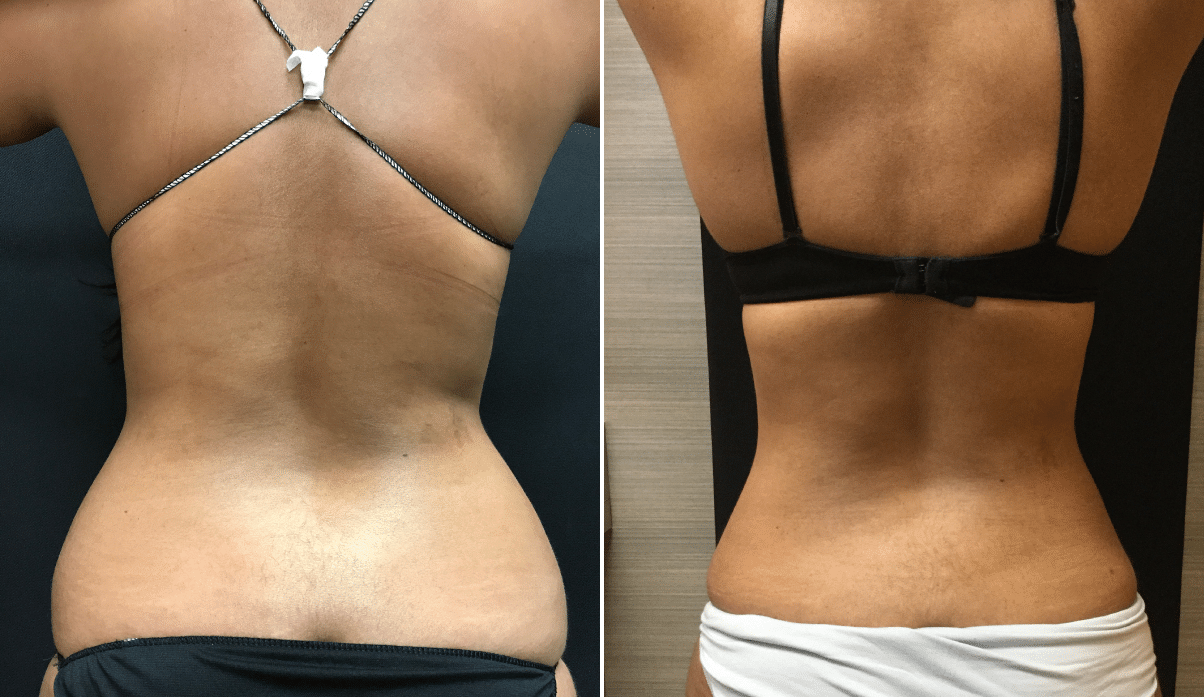 Lipo 360: Achieving a Snatched Waist with Confidence - Laser Lipo