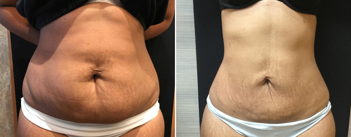 https://www.reflectionscenter.com/wp-content/uploads/2022/01/vaser-smartlipo-hips-waist-tummy-61359-30yo-hispanic-mom-sideview-after-1month-new-jersey.png