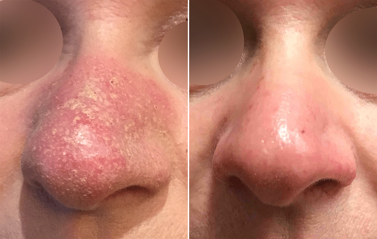 acne rosacea before after
