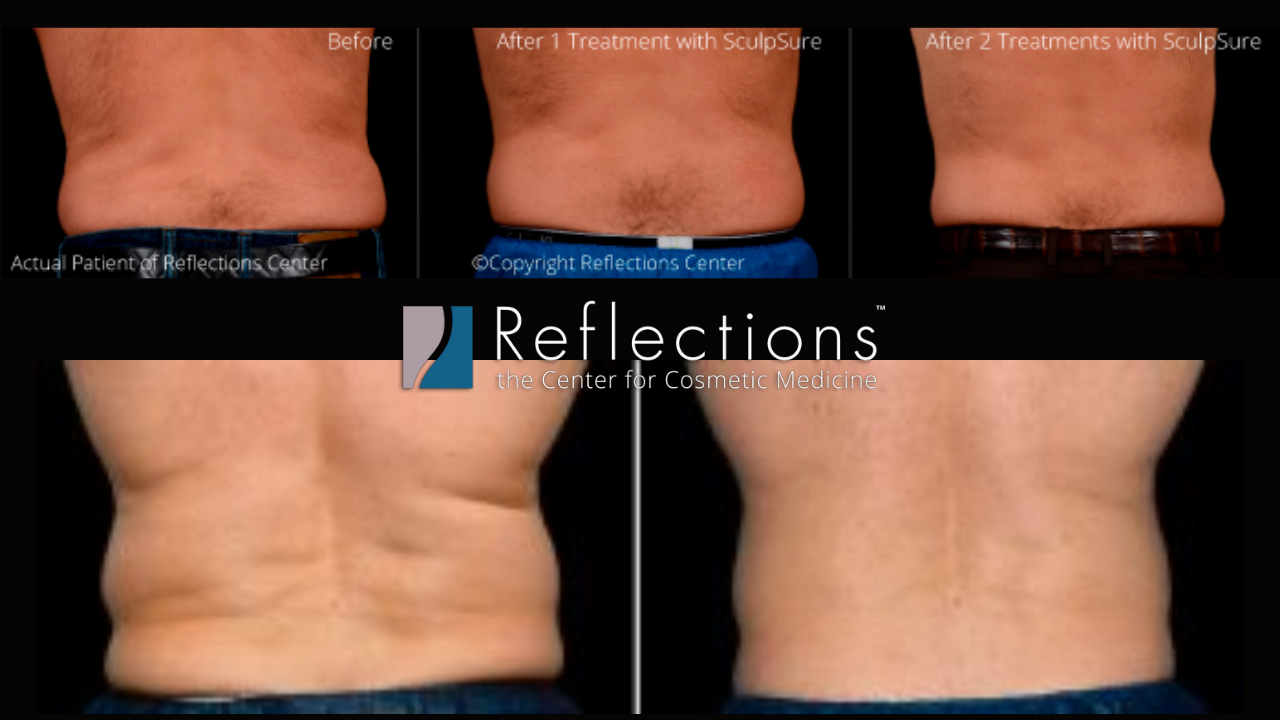 Love Handles Before and After Photos, Non-Surgical treatment for