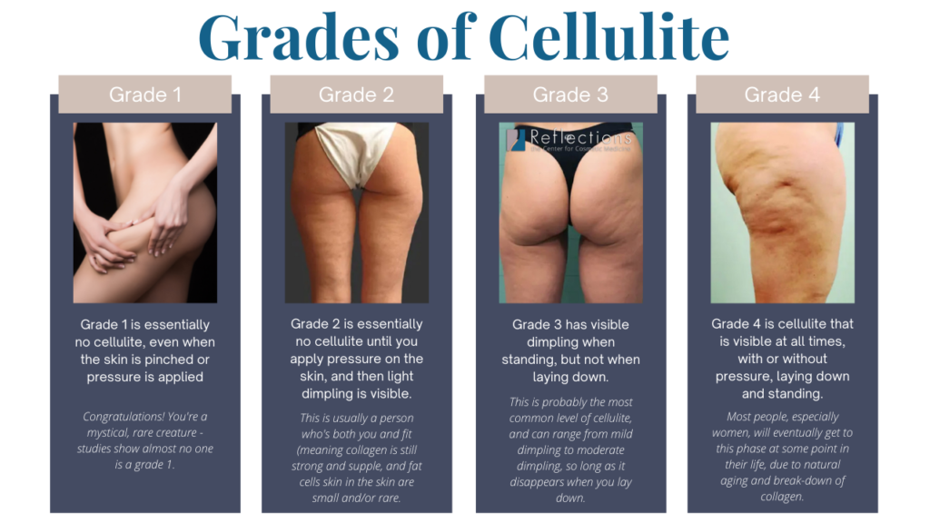 Marking target areas for cellulite reduction (a). examples of planned