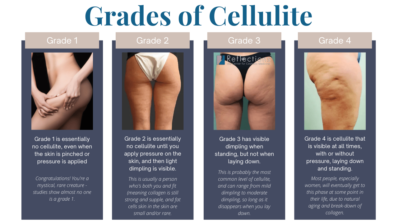 https://www.reflectionscenter.com/wp-content/uploads/2022/09/Grades-of-Cellulite-Understanding-How-to-Treat-Cellulite.png