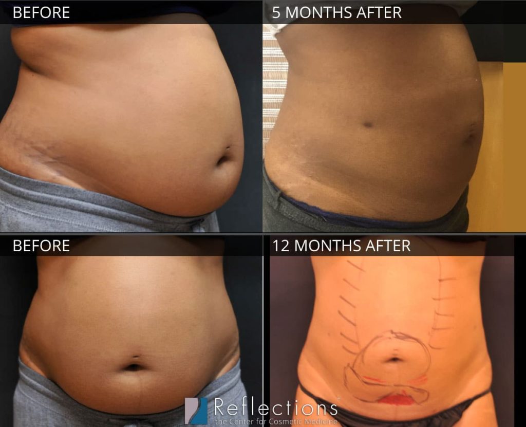 I Tried SculpSure Fat-Burning Laser Treatment After Giving Birth