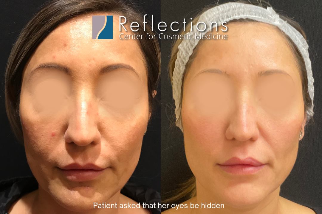 Clear + Brilliant Laser for Clear & Brilliant Skin Over 40 Before & After  Photos New Jersey - Reflections Center