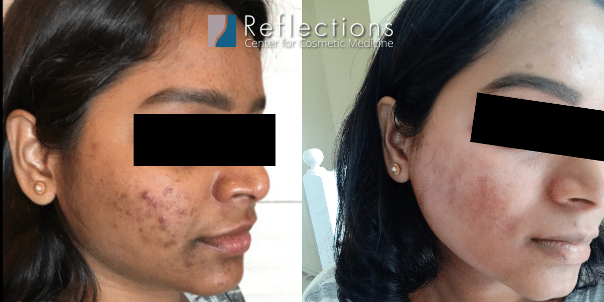 acne scars before and after laser