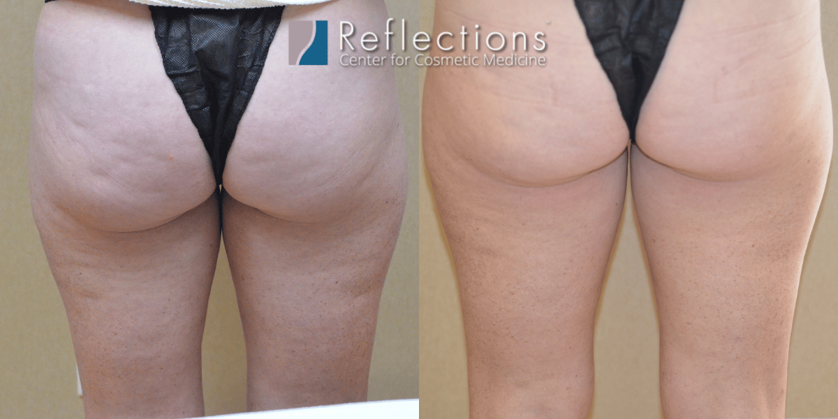 Cellulite Buttocks