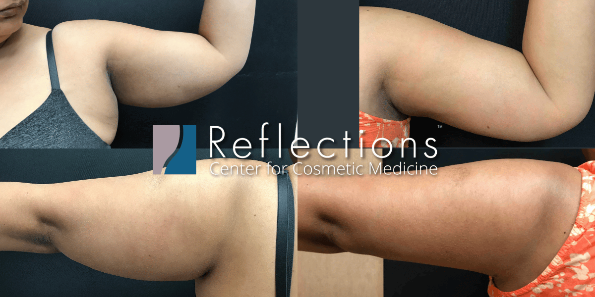 Female Arm Liposuction Before After Photos