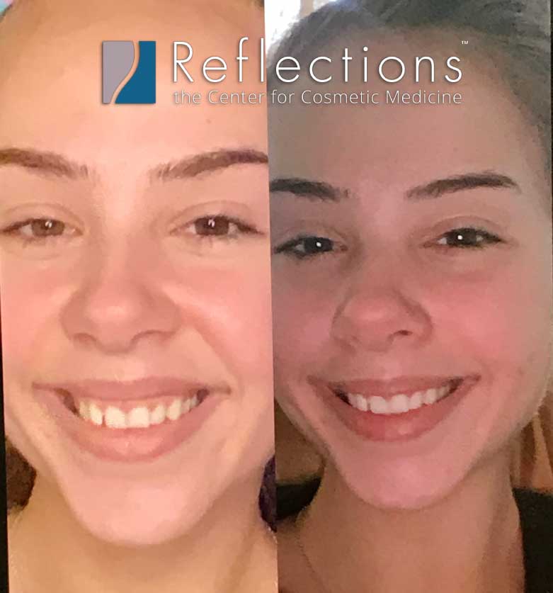 Fixing A Gummy Smile Using Botox Reflections Center