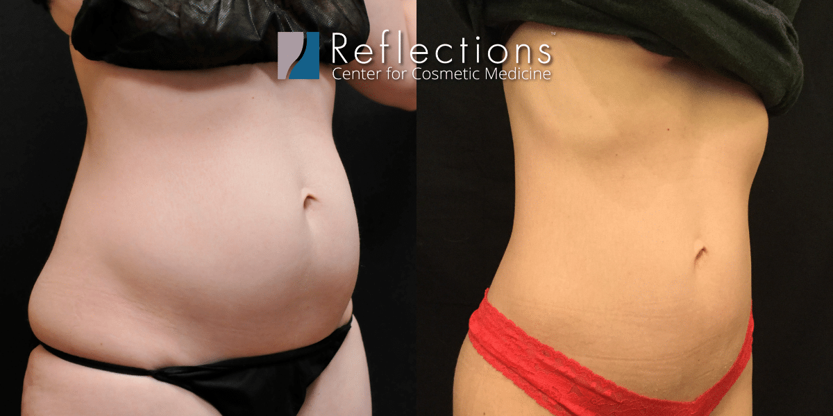 Laser Lipo For Slim Toned Abs Love Handles Before After Photos