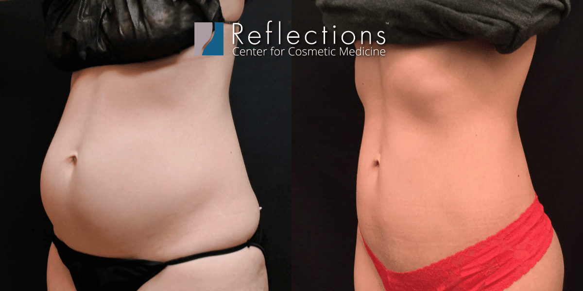 Laser Liposuction Before & After Photos New Jersey