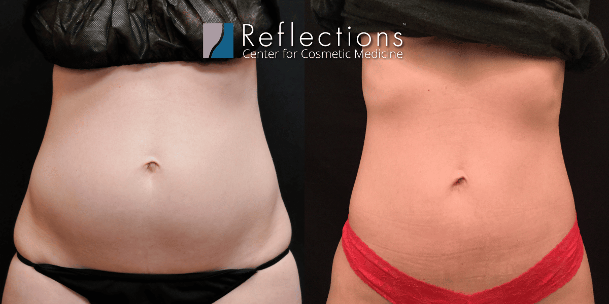 Laser Lipo 360 for Slim, Toned Abs & Love Handles Before & After