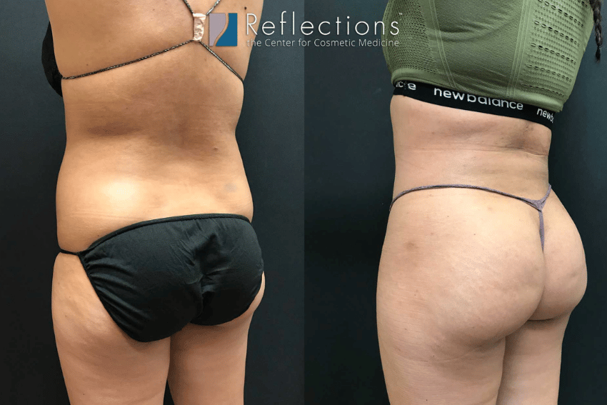 Battle of the Butt Lifts: Is Brazilian or Sculptra Best for You? - The  Lifestyle Center The Lifestyle Center